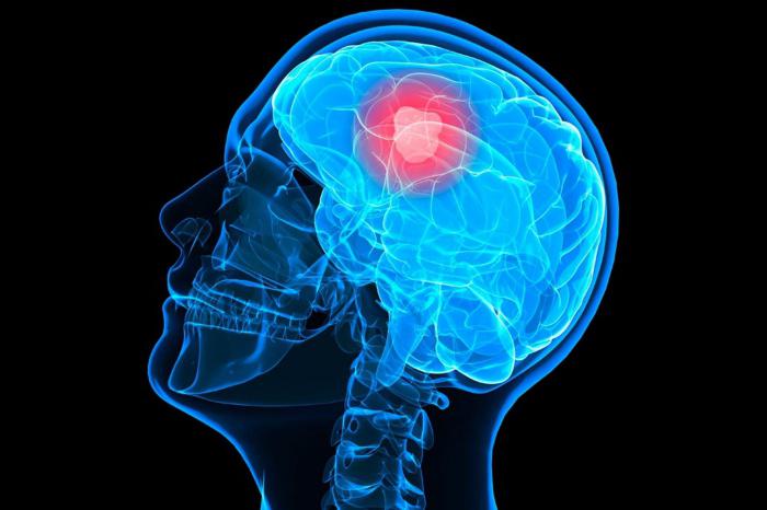 First clinical trials of brain cancer immune therapy succeed and account for individual genetic features